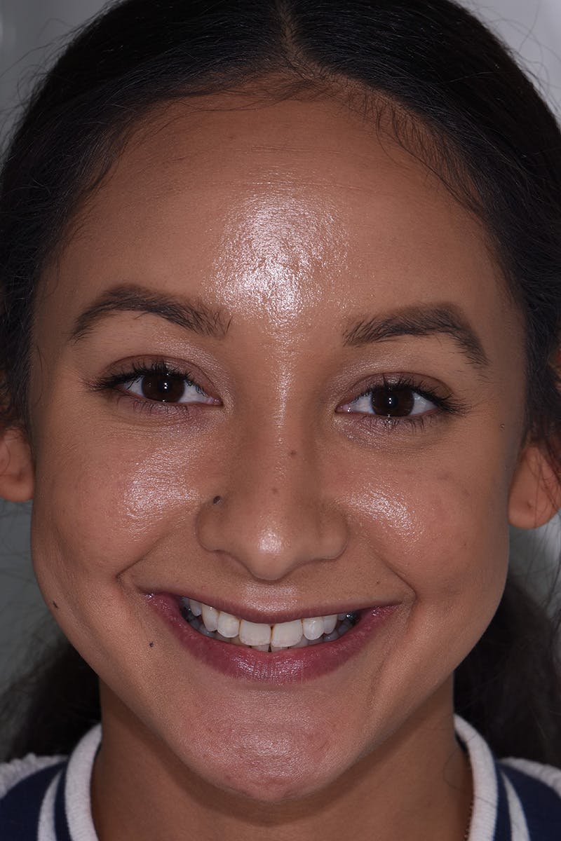 Patient Smile Before & After Gallery - Patient 271730 - Image 1