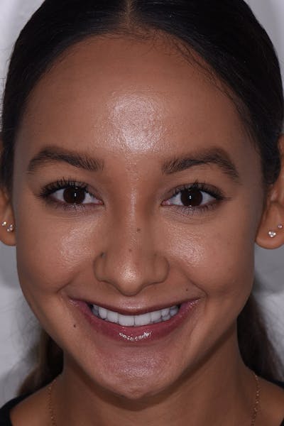 Patient Smile Before & After Gallery - Patient 271730 - Image 2