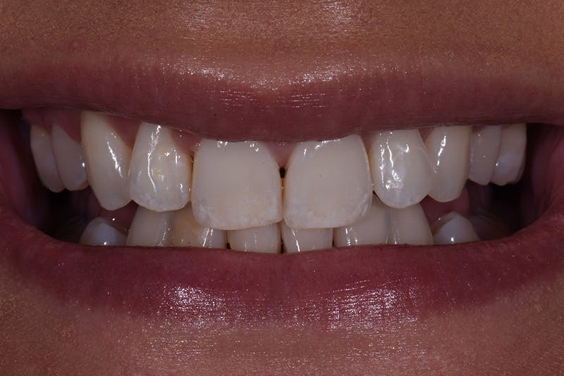 Patient Smile Before & After Gallery - Patient 271730 - Image 3