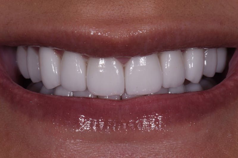 Patient Smile Before & After Gallery - Patient 271730 - Image 4