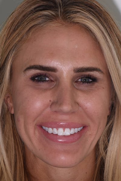 Patient Smile Before & After Gallery - Patient 136409 - Image 1