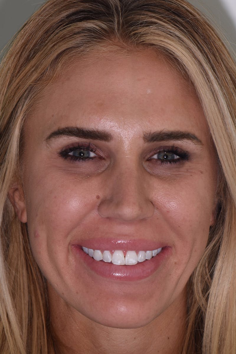 Patient Smile Before & After Gallery - Patient 136409 - Image 1