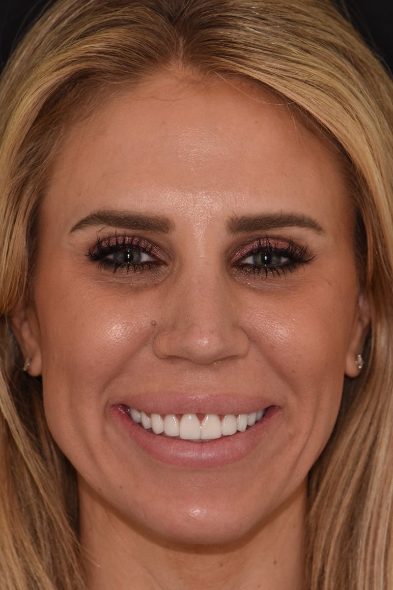 Patient Smile Before & After Gallery - Patient 136409 - Image 2