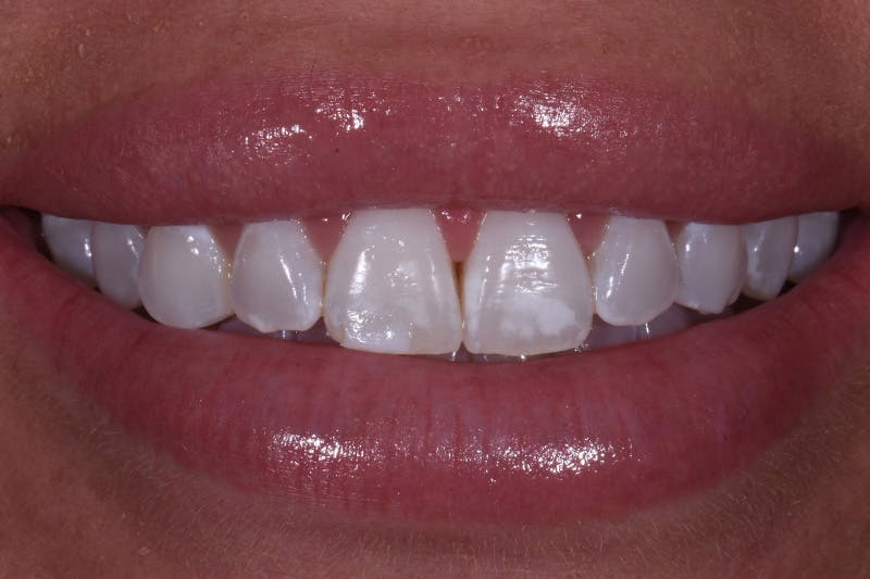 Patient Smile Before & After Gallery - Patient 136409 - Image 3