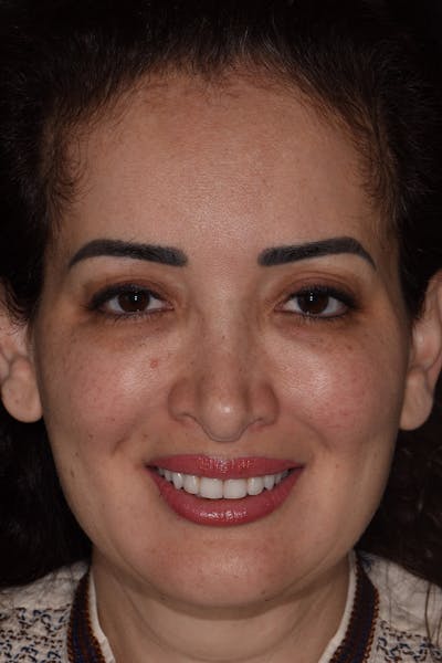 Patient Smile Before & After Gallery - Patient 350272 - Image 2