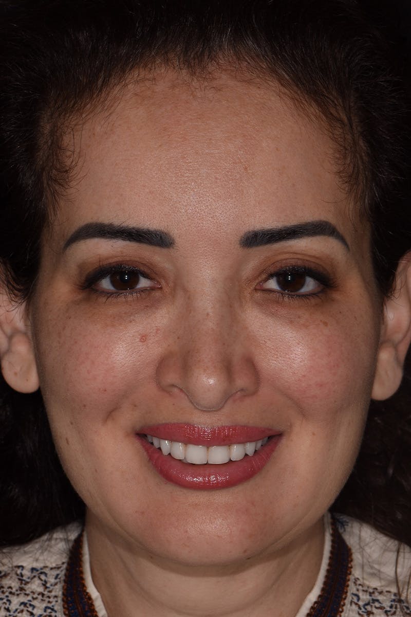 Patient Smile Before & After Gallery - Patient 350272 - Image 2