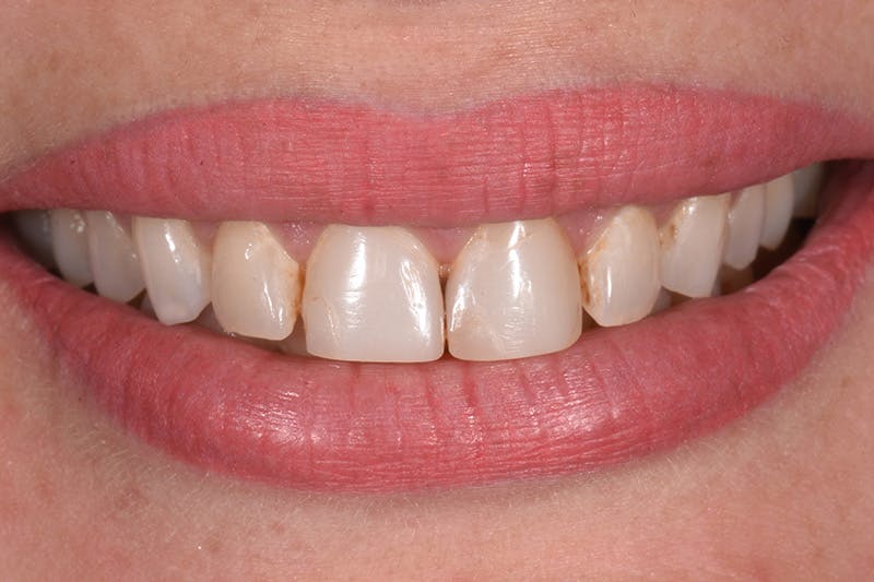 Patient Smile Before & After Gallery - Patient 350272 - Image 3