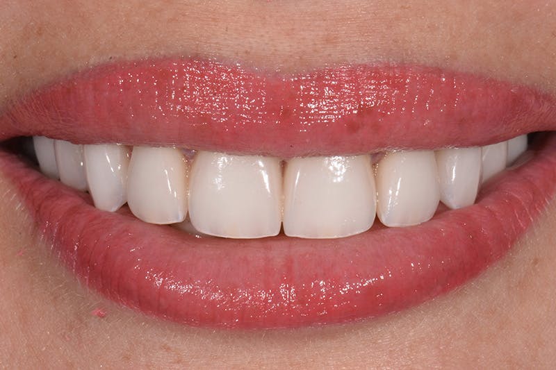 Patient Smile Before & After Gallery - Patient 350272 - Image 4