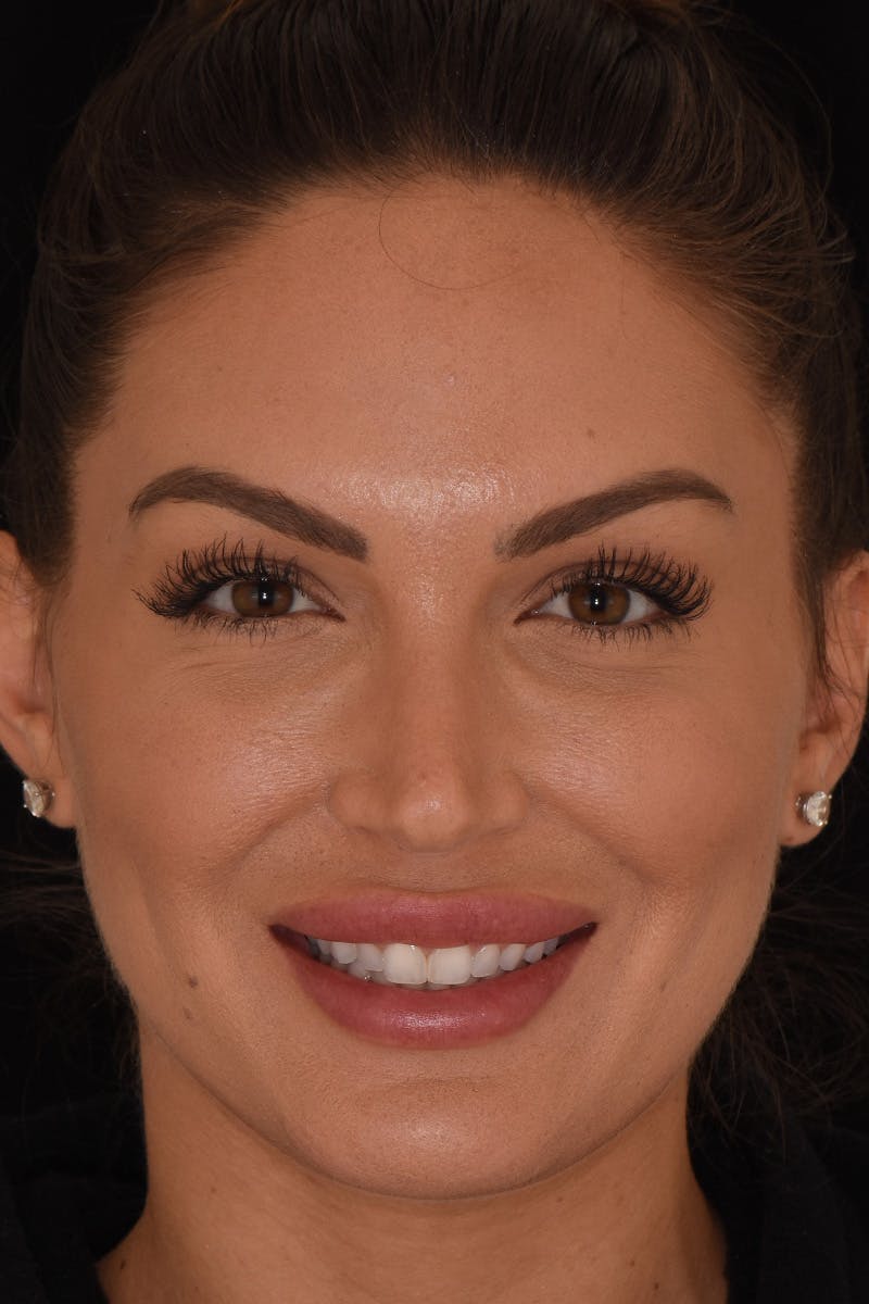 Patient Smile Before & After Gallery - Patient 158945 - Image 1