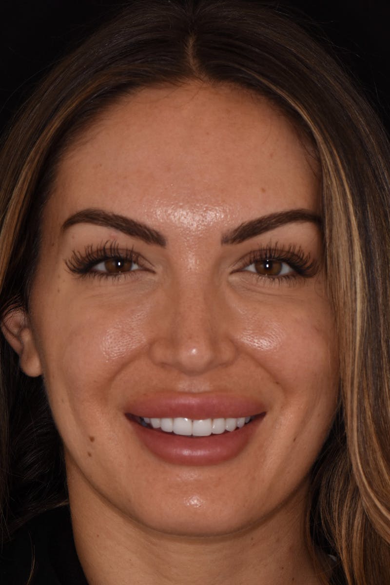 Patient Smile Before & After Gallery - Patient 158945 - Image 2