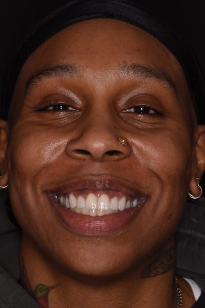 Patient Smile Before & After Gallery - Patient 269913 - Image 2
