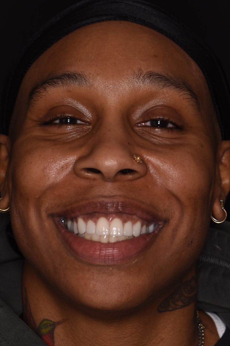 Patient Smile Before & After Gallery - Patient 269913 - Image 2