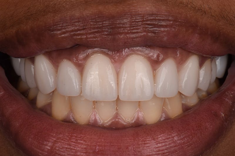 Patient Smile Before & After Gallery - Patient 269913 - Image 4