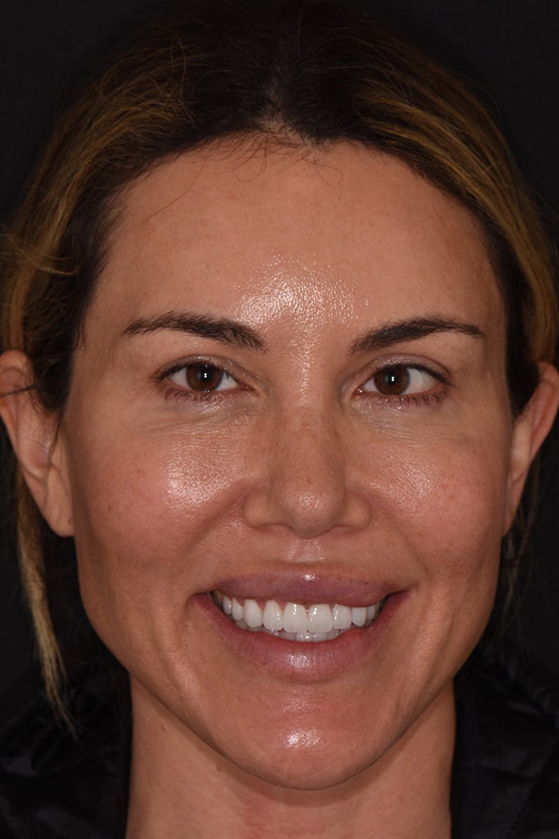 Patient Smile Before & After Gallery - Patient 167863 - Image 2