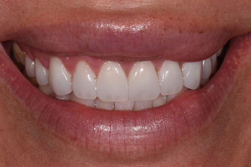 Patient Smile Before & After Gallery - Patient 167863 - Image 4