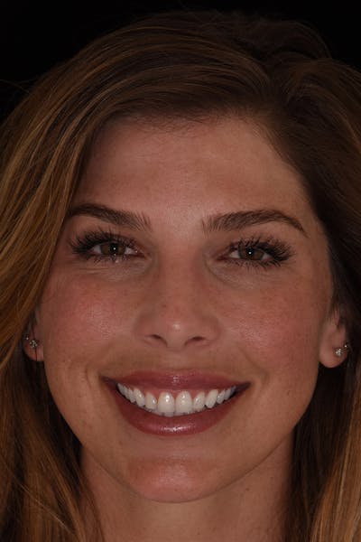 Patient Smile Before & After Gallery - Patient 552362 - Image 1