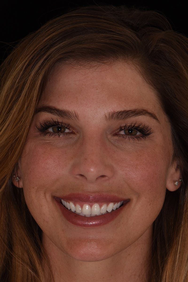 Patient Smile Before & After Gallery - Patient 552362 - Image 1