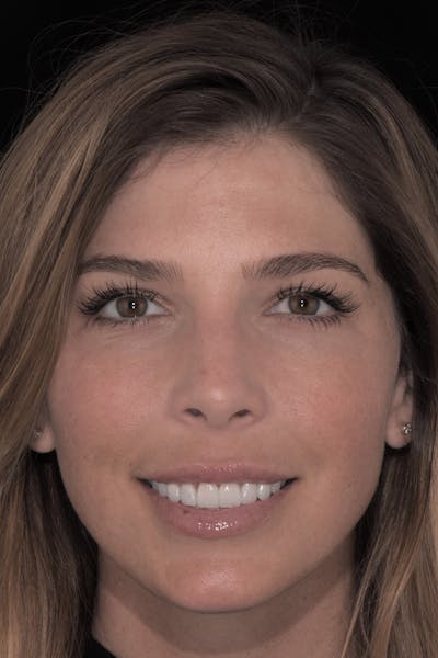Patient Smile Before & After Gallery - Patient 552362 - Image 2