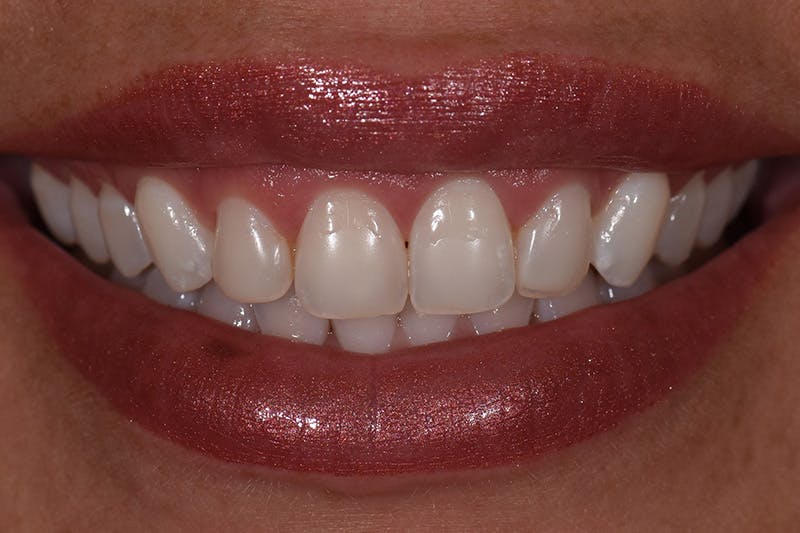 Patient Smile Before & After Gallery - Patient 552362 - Image 3