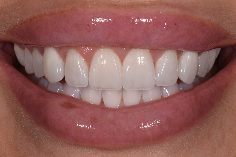 Patient Smile Before & After Gallery - Patient 552362 - Image 4