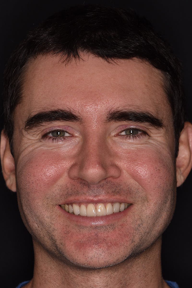 Patient Smile Before & After Gallery - Patient 245916 - Image 1