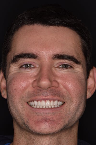 Patient Smile Before & After Gallery - Patient 245916 - Image 2