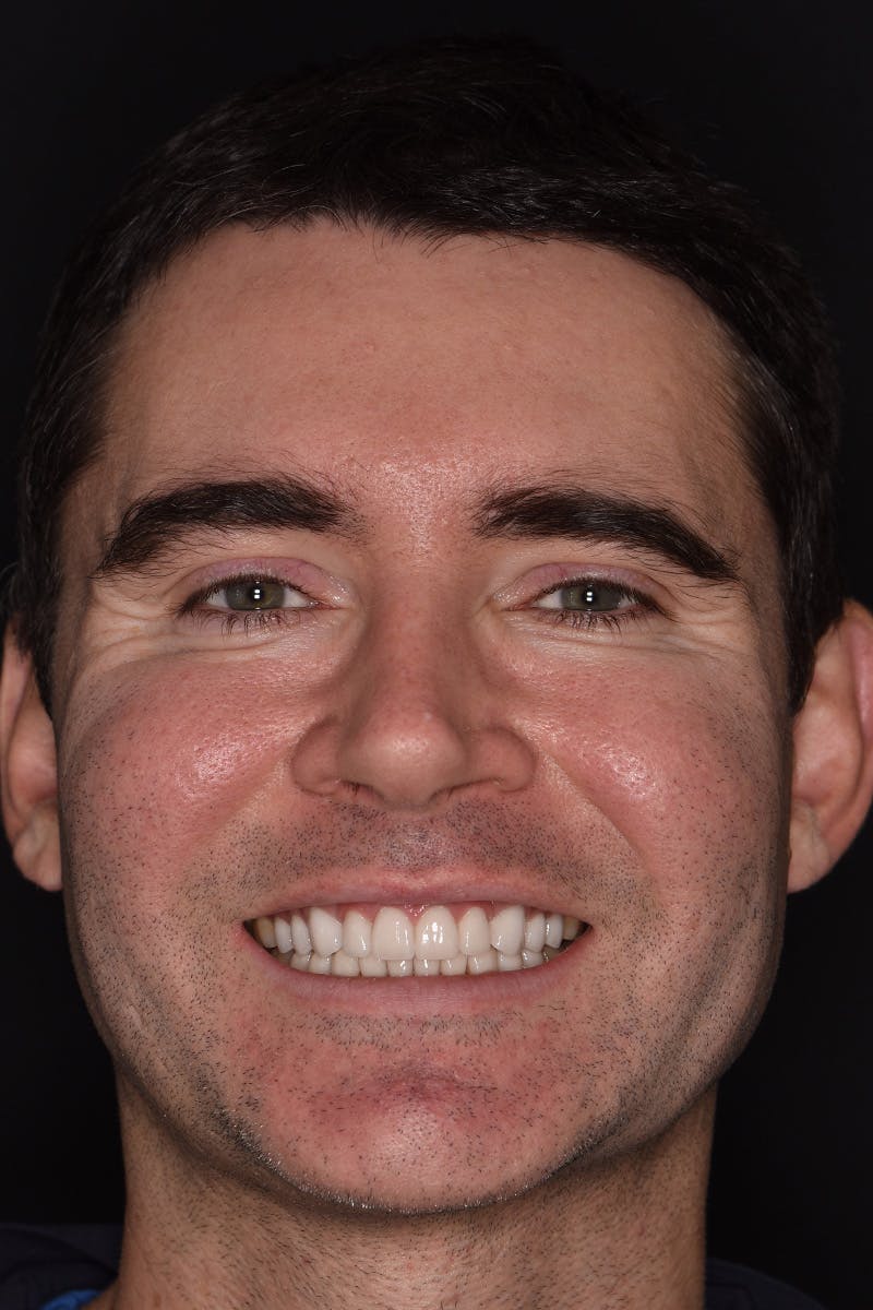 Patient Smile Before & After Gallery - Patient 245916 - Image 2