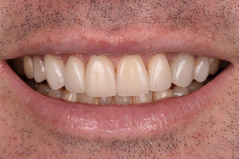 Patient Smile Before & After Gallery - Patient 245916 - Image 3