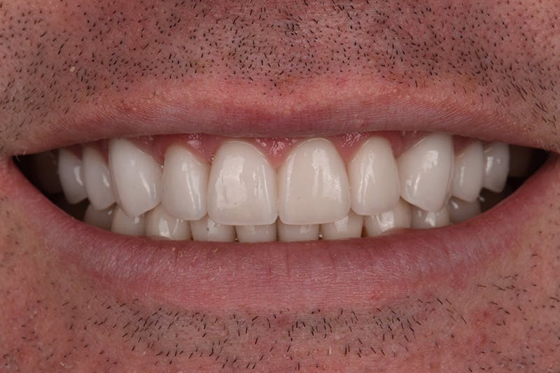 Patient Smile Before & After Gallery - Patient 245916 - Image 4