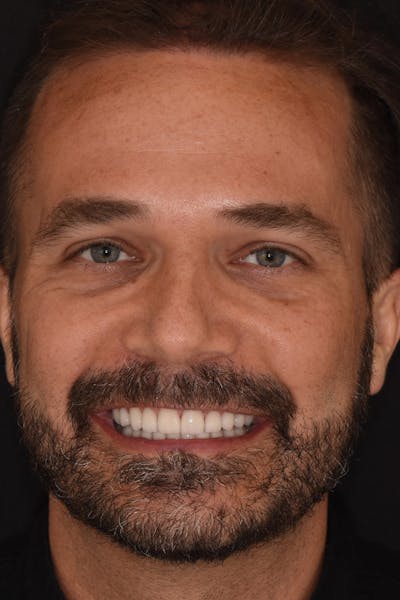 Patient Smile Before & After Gallery - Patient 347431 - Image 2