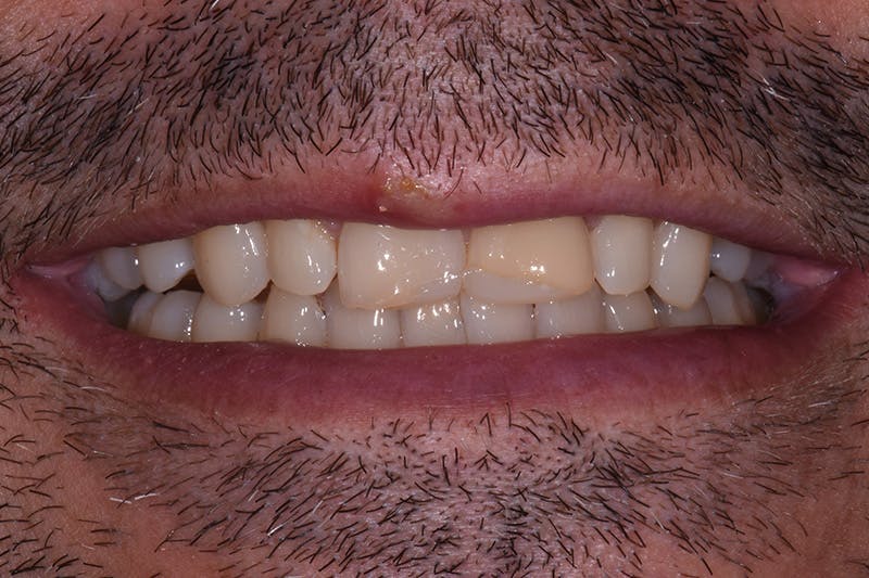 Patient Smile Before & After Gallery - Patient 347431 - Image 3
