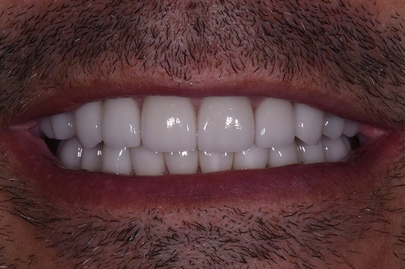 Patient Smile Before & After Gallery - Patient 347431 - Image 4