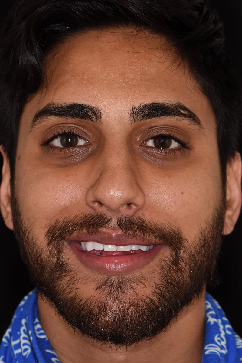 Patient Smile Before & After Gallery - Patient 738058 - Image 1