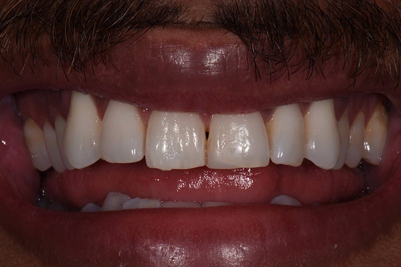 Patient Smile Before & After Gallery - Patient 738058 - Image 3