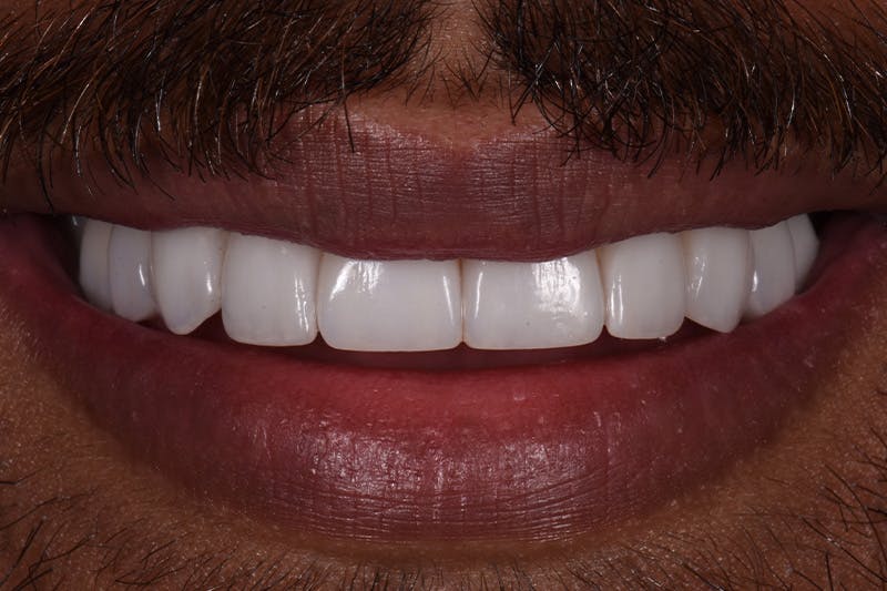 Patient Smile Before & After Gallery - Patient 738058 - Image 4