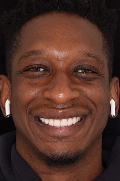 Patient Smile Before & After Gallery - Patient 912821 - Image 2