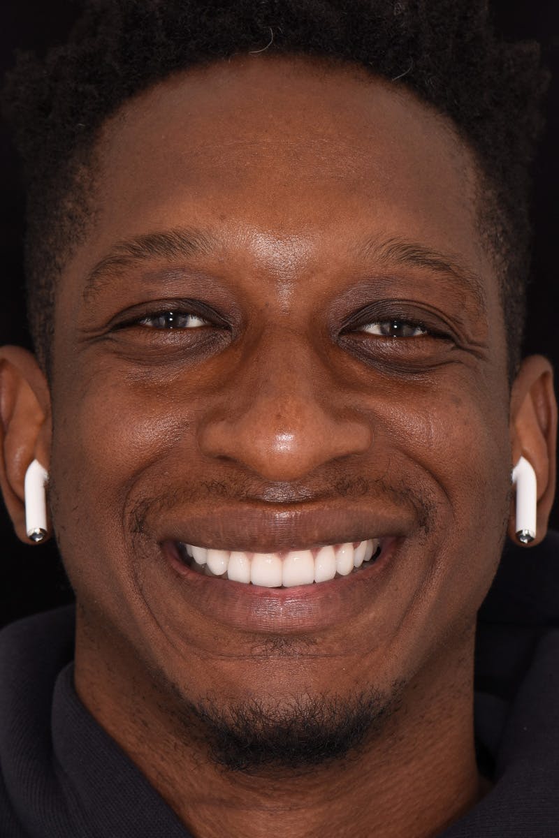 Patient Smile Before & After Gallery - Patient 912821 - Image 2