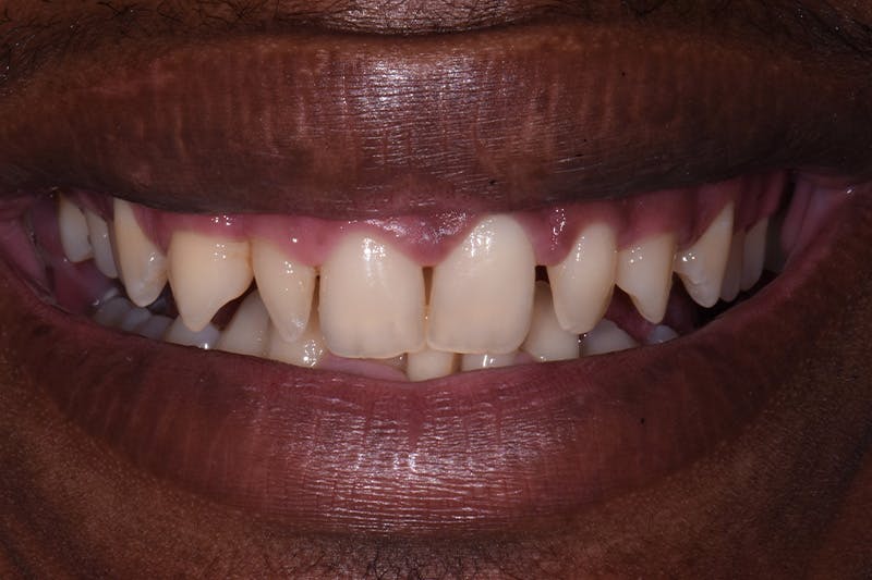 Patient Smile Before & After Gallery - Patient 912821 - Image 3