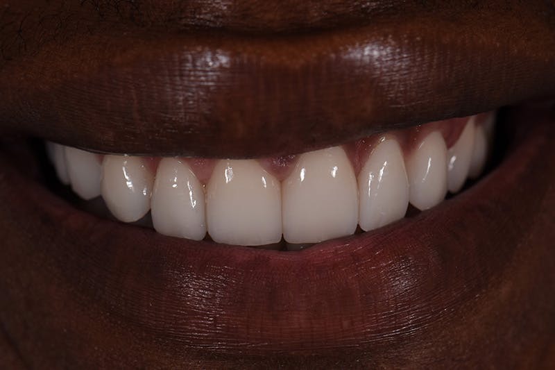 Patient Smile Before & After Gallery - Patient 912821 - Image 4