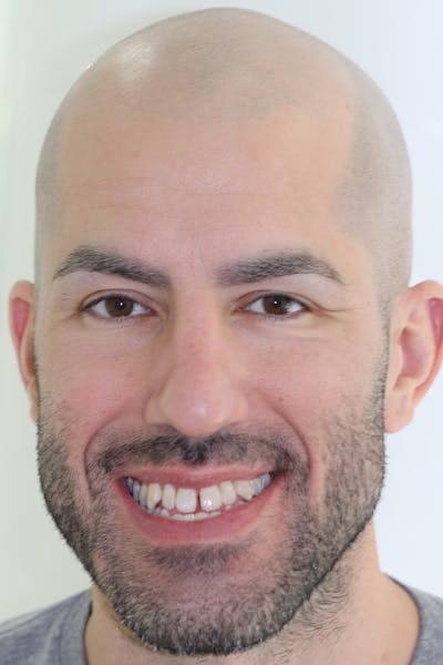 Patient Smile Before & After Gallery - Patient 350050 - Image 1