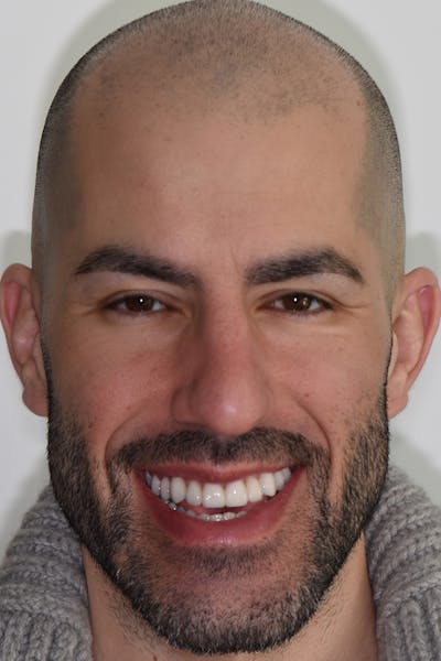 Patient Smile Before & After Gallery - Patient 350050 - Image 2