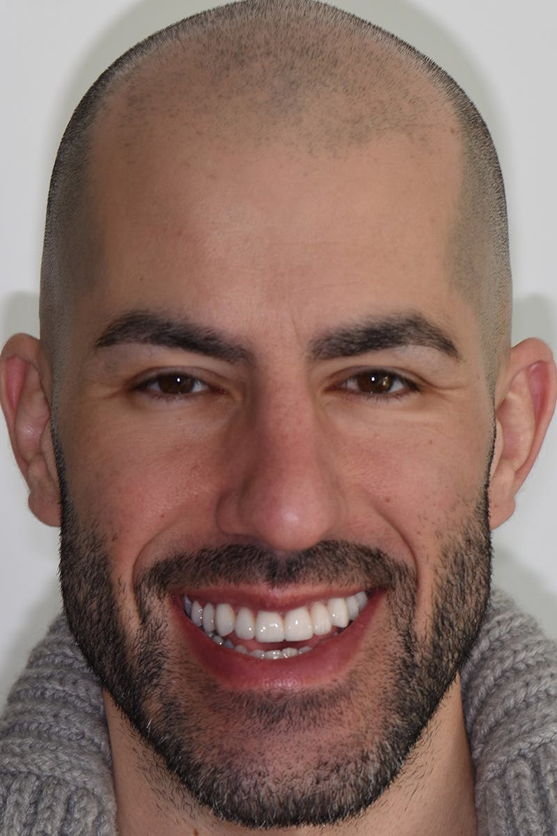 Patient Smile Before & After Gallery - Patient 350050 - Image 2