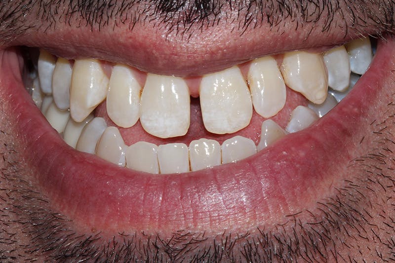 Patient Smile Before & After Gallery - Patient 350050 - Image 3