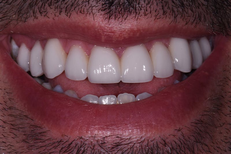 Patient Smile Before & After Gallery - Patient 350050 - Image 4