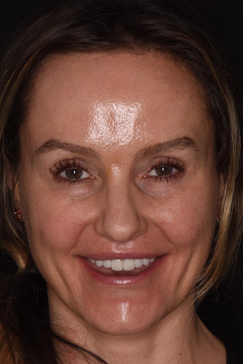 Patient Smile Before & After Gallery - Patient 418932 - Image 2