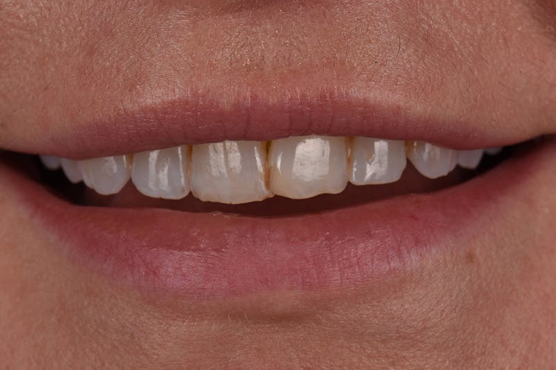 Patient Smile Before & After Gallery - Patient 418932 - Image 3
