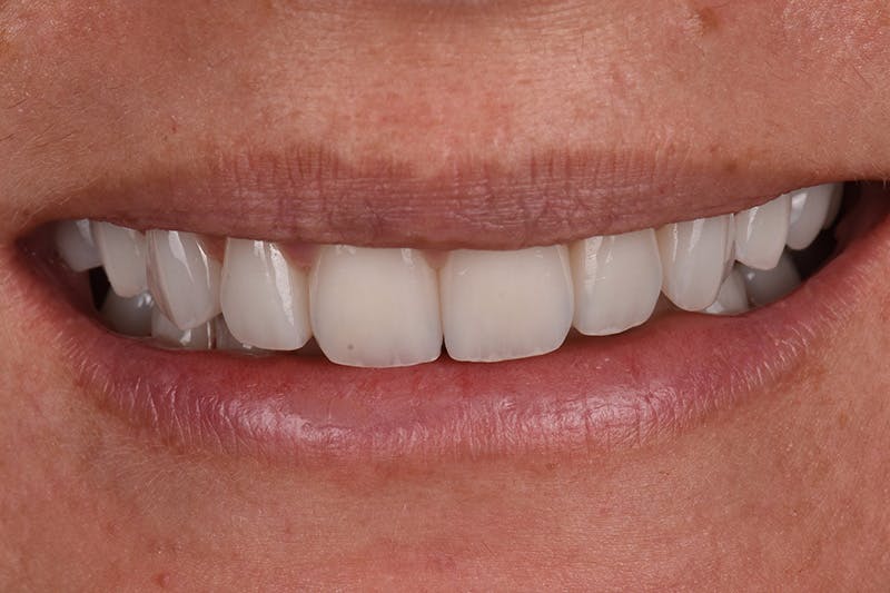 Patient Smile Before & After Gallery - Patient 418932 - Image 4