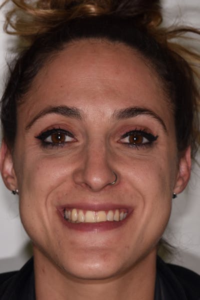 Patient Smile Before & After Gallery - Patient 157410 - Image 1