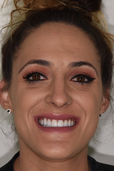 Patient Smile Before & After Gallery - Patient 157410 - Image 2