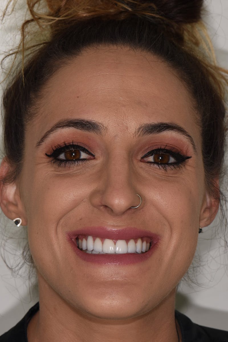 Patient Smile Before & After Gallery - Patient 157410 - Image 2